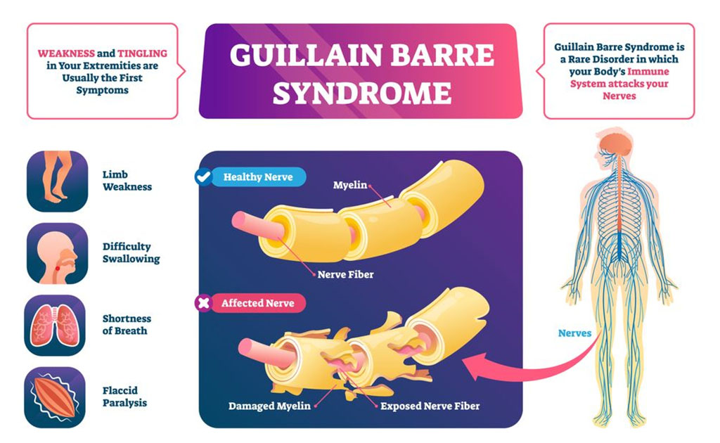 গুইলেন-ব্যারি-সিনড্রোম